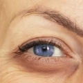 Can Dermal Fillers Be Used Under the Eyes?