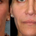 Can Dermal Fillers Lift Jowls? A Comprehensive Guide