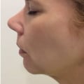 Can Filler Lift Your Jawline?