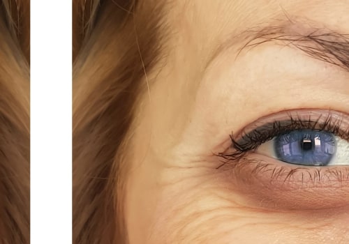 Can Dermal Fillers Be Used Under the Eyes?