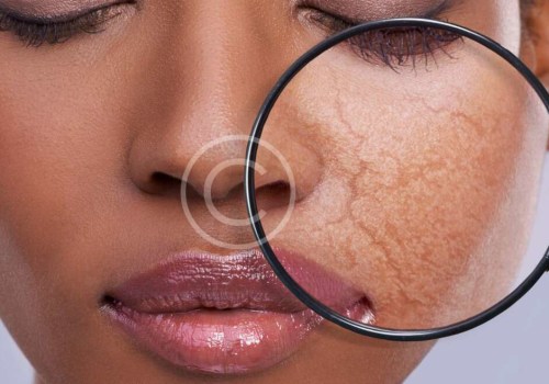 Dermal fillers