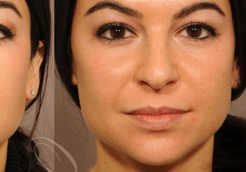 Where to Find the Best Dermal Fillers Near Me?