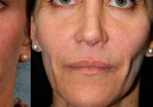 Can Permanent Dermal Fillers Give You a Lasting Look?